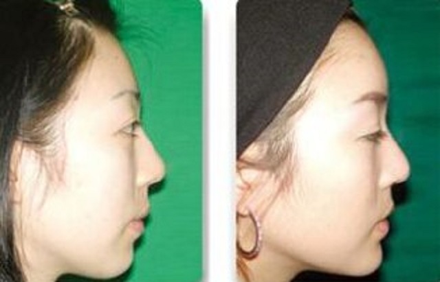 额头填充那些帮你变的更美丽的小秘密，你知道吗？