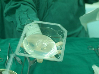 硅胶隆胸多少钱 大概费用多少呢跟小编来了解下