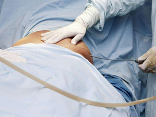 抽脂减肥过程疼吗  过程疼还是抽脂后疼进来详看