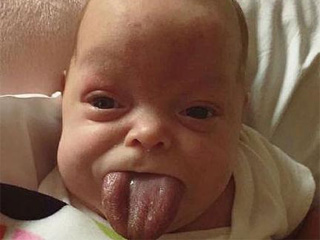 新生女婴长巨舌 惊人大舌头塞满嘴巴往外生长太可怕