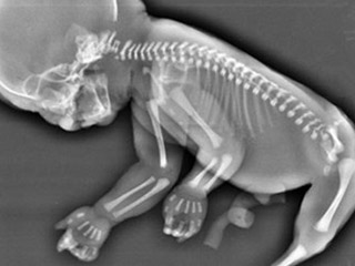 妈妈怀上人鱼宝宝 或因遗传基因致畸形不能生存下来