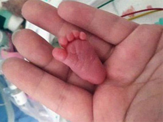 世界最轻婴儿0.4斤 粉碎夭折噩梦存活堪称人类史上奇迹