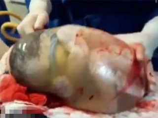 西班牙产妇产巨蛋 婴儿裹胎膜出生犹如透明鸡蛋令人称奇
