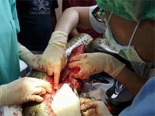 医院为巨蟒切除心脏肿瘤 因食欲减退竟是肿瘤作怪令人惊呆