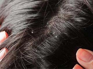 头屑多掉头发的原因 脱发10大原因少不了头屑搞鬼