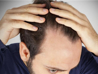 男士脱发原因及治疗  脱发严重？那快收走这几个解决偏方