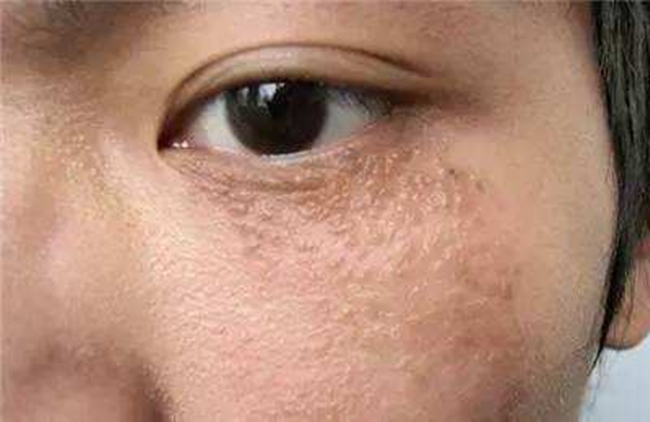 眼部扁平疣初期图片 扁平疣的早期症状80%的人都不知道