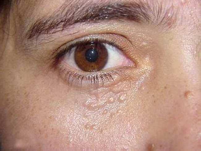 眼部扁平疣初期图片 扁平疣的早期症状80%的人都不知道