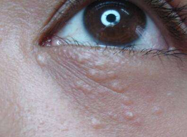 眼部扁平疣初期图片 扁平疣的早期症状80%的人都不知道