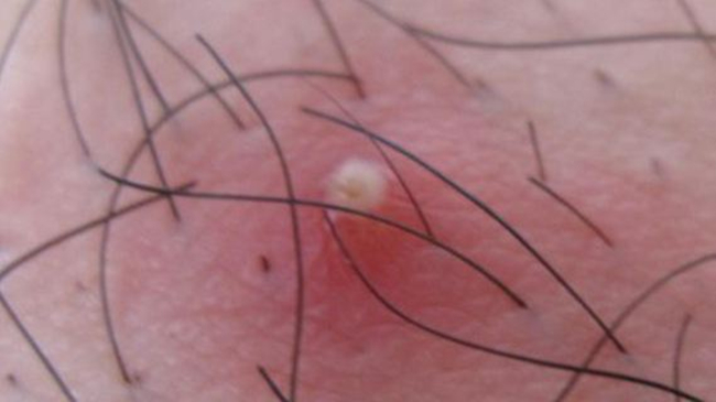 得了毛囊炎如何治疗好 毛囊炎的治疗小妙招饮食更重要