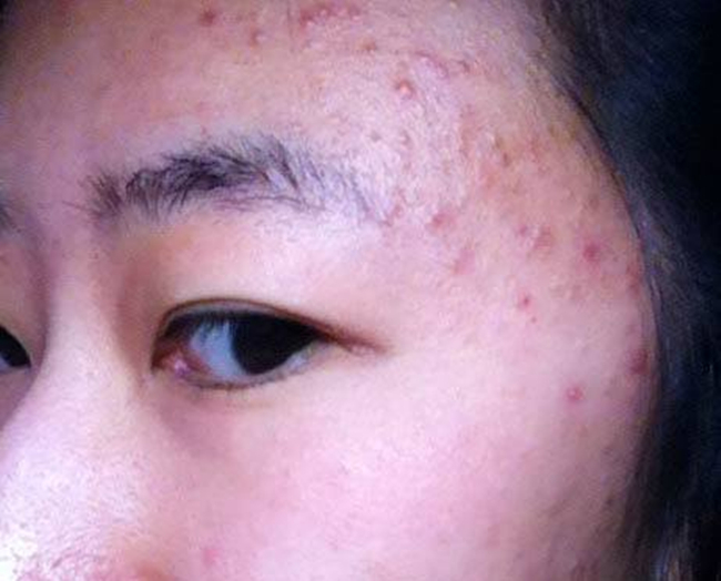 得了毛囊炎如何治疗好 毛囊炎的治疗小妙招饮食更重要