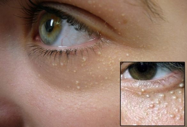 脸上脂肪粒图片大全 全面解读脂肪粒治疗少走弯路