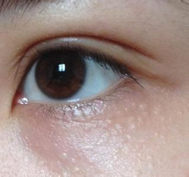 脸上脂肪粒图片大全 全面解读脂肪粒治疗少走弯路