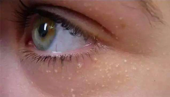 脸上脂肪粒图片大全 全面解读脂肪粒治疗少走弯路