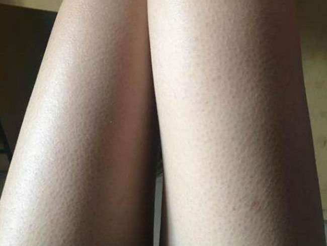 鸡皮疙瘩皮肤怎么治 鸡皮疙瘩长时间不消退身体在渴求它