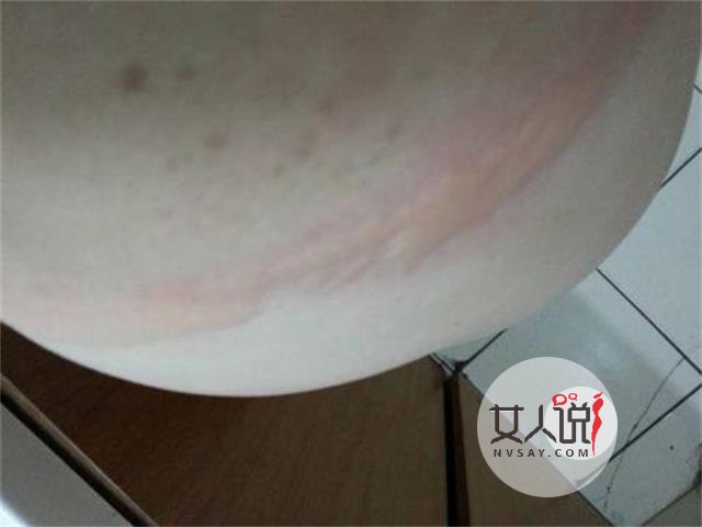 荨麻疹图片,做好心理准备再看哦!