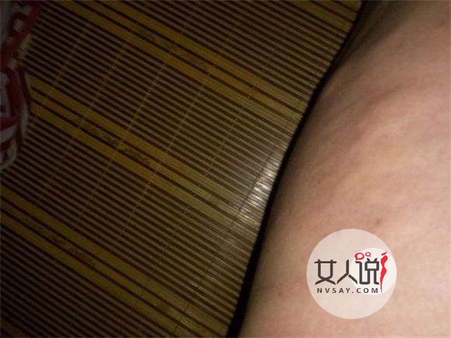 荨麻疹图片,做好心理准备再看哦!