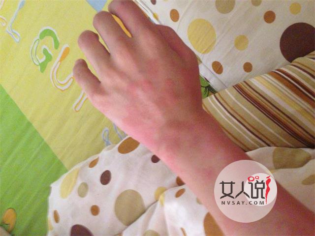 荨麻疹图片,做好心理准备再看哦!