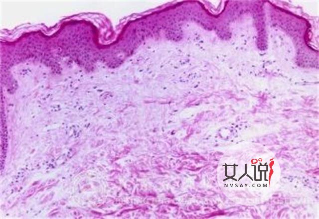 荨麻疹图片，做好心理准备再看哦！
