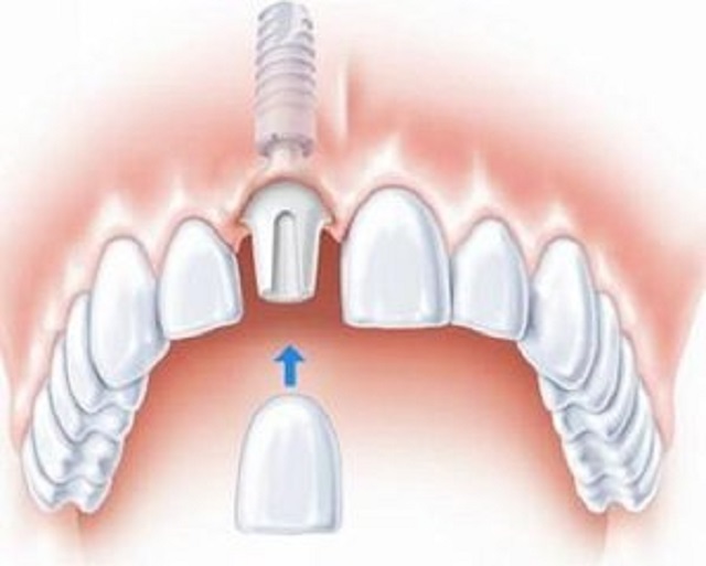 种植牙价格，种植牙有什么需要注意的事项，看这里就对了