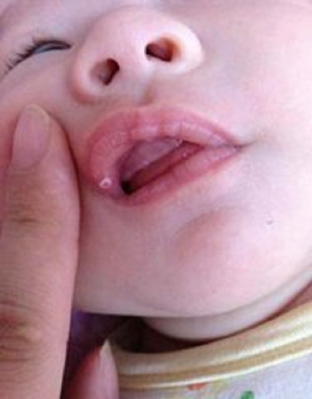 鹅口疮图片告诉你答案，千万别小看，有时甚至危及生命！！！