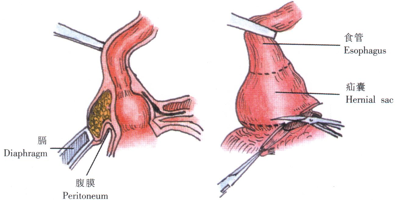 食道炎是什么？你知道食道炎的症状吗？