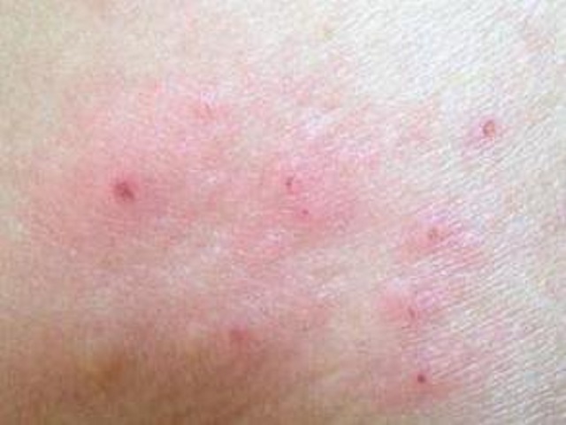 过敏性皮炎真的很让人苦恼，教你一招轻松应对它