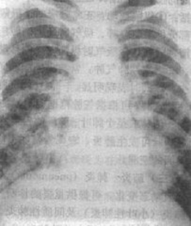 小孩支气管肺炎，你没办法？不能错过的小知识