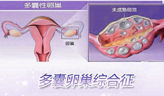 多囊卵巢综合症不是事？你摊上大事了！