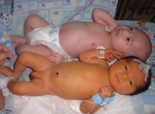 新生儿中高发的黄疸起因为何？黄疸应如何治疗