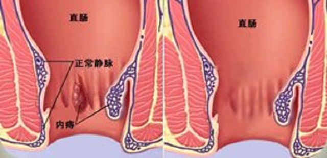 痔疮便血？不知道怎么办？看看这里就知道啦