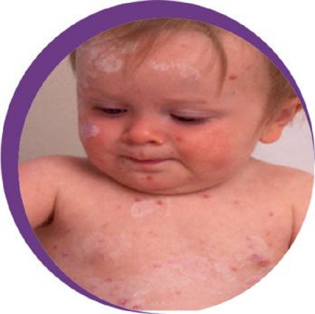 水痘图片好吓人！如何治疗好关键！