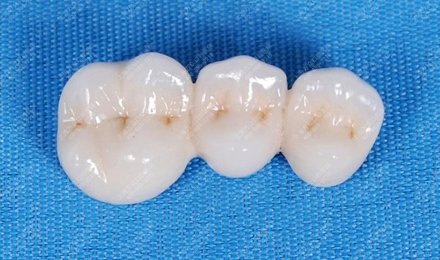 烤瓷牙价格表详细介绍，一口好牙笑出精彩人生！